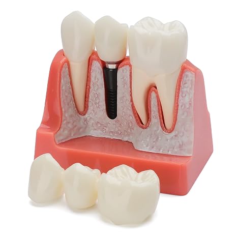 Dental Implant Model - Implant Vs Bridge Dental Model 4 Times Removable Analysis Crown Bridge Demonstration Teeth Model